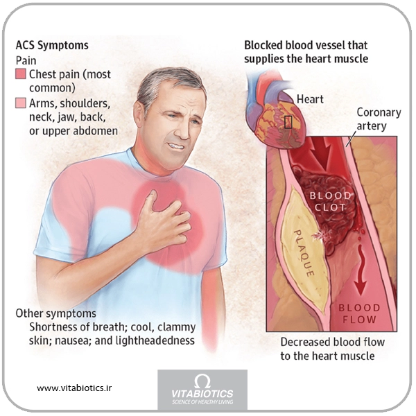 سندرم کرونری حاد و راه های پیشگیری آن